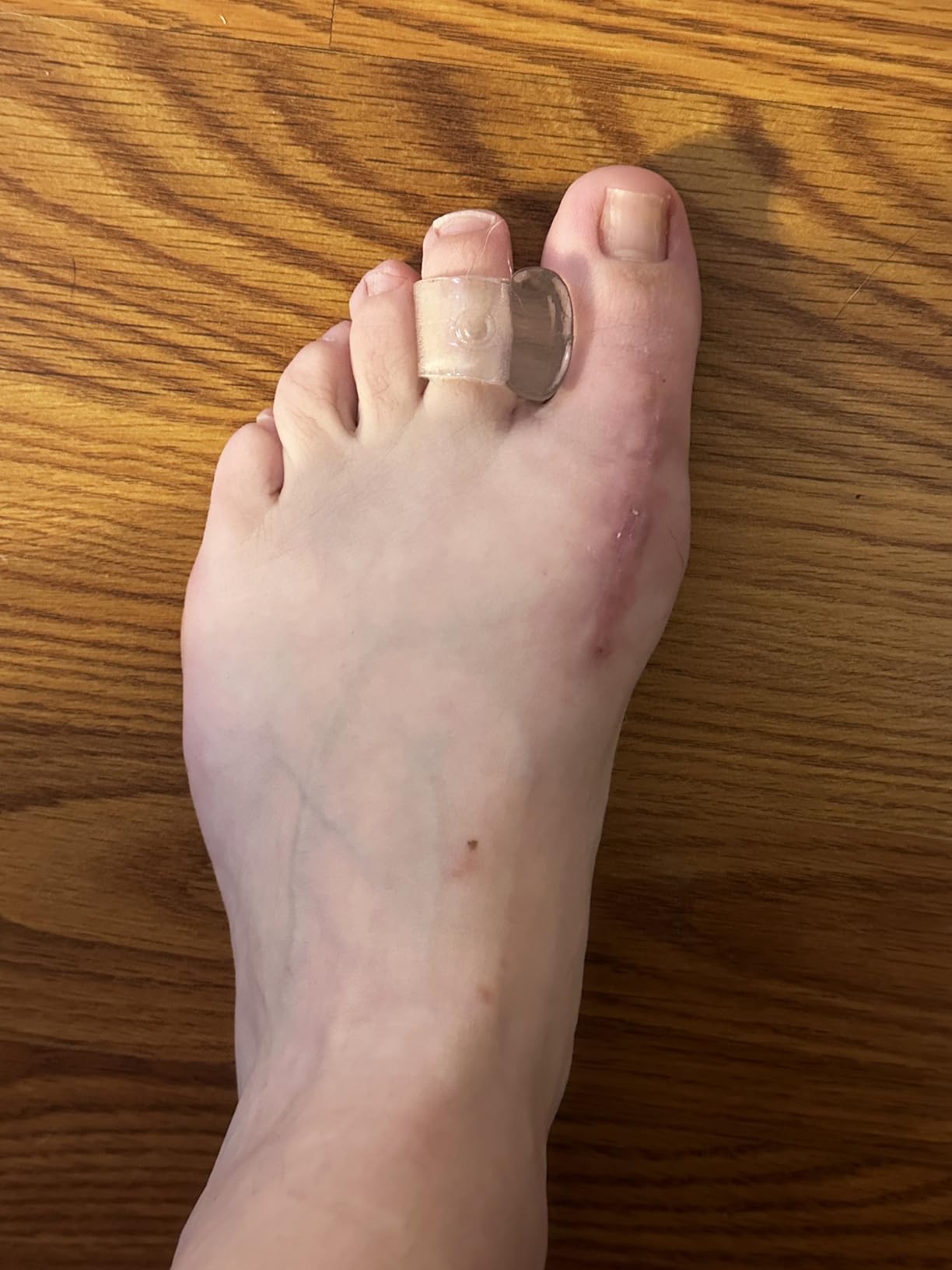 ZenToes Gel Toe Spacers for Bunions & Overlapping Toes, 4 Count customer photo 1