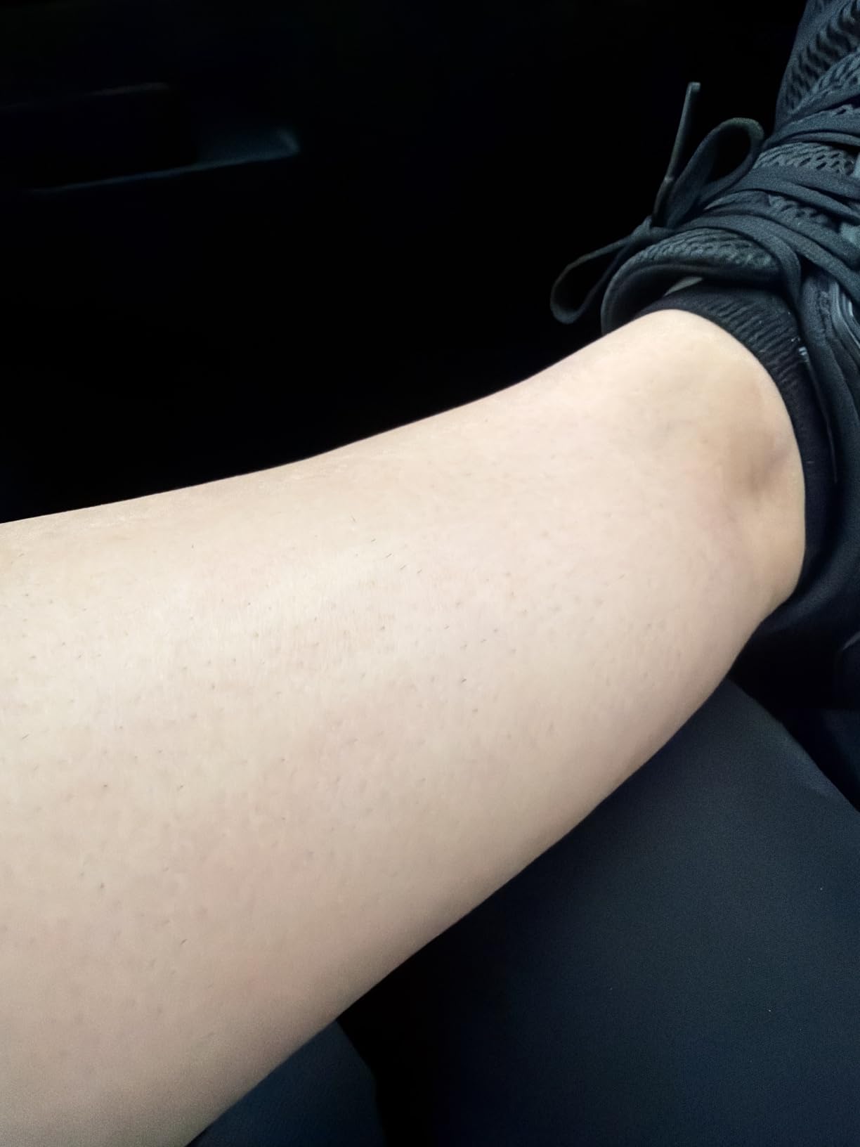 Philips Lumea IPL - Salon-Like Laser Hair Removal for Women, Permanent Hair Reduction Device At Home for Face & Body - Safe & Painless, 5 Settings & Skin Sensors, BRI984/03 customer photo 1